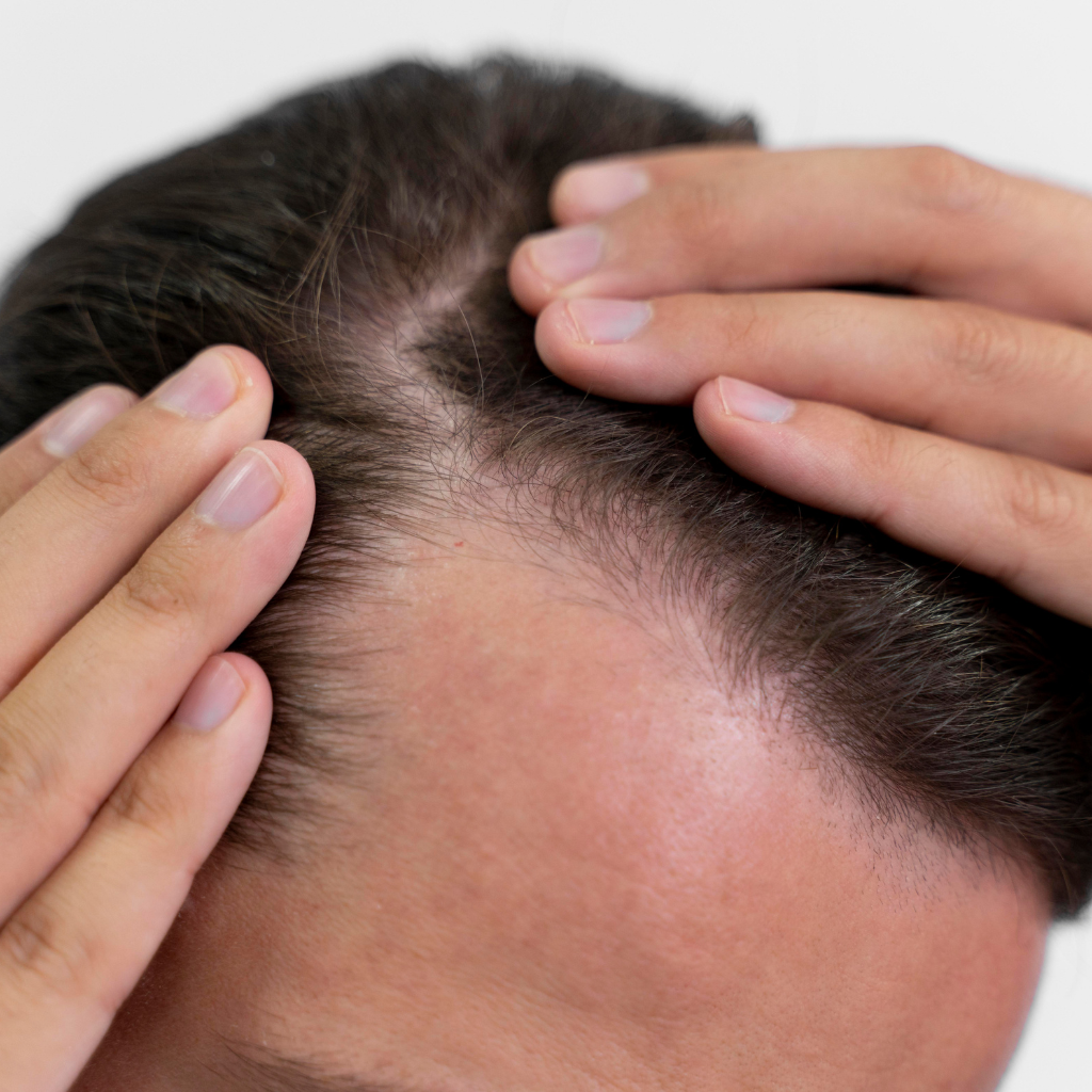 La caduta dei capelli e la sua causa